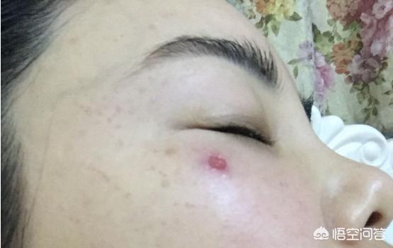 光子嫩肤怎么做视频
:光子嫩肤，医学原理是什么，靠谱吗？  第4张
