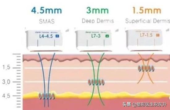 超声刀超做视频
:什么人适合做超声刀？  第2张