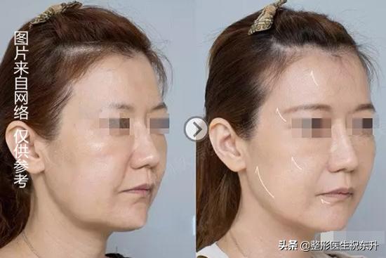 超声刀超做视频
:什么人适合做超声刀？  第3张