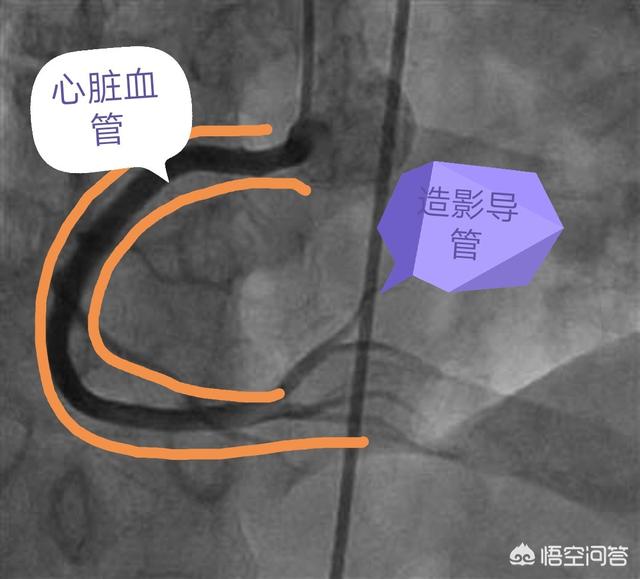 心脏造影怎么做视频
:心脏造影怎么做？  第2张