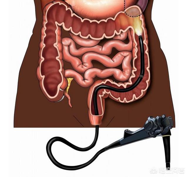 肠胃镜怎么做的过程视频
:最近肠胃不太好，请问做过肠胃镜的朋友，是做肠镜痛苦还是胃镜痛苦？  第3张