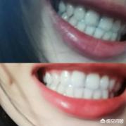 爱牙日宣传视频:爱牙日就要来了，你有什么牙齿美白秘籍吗？  第1张