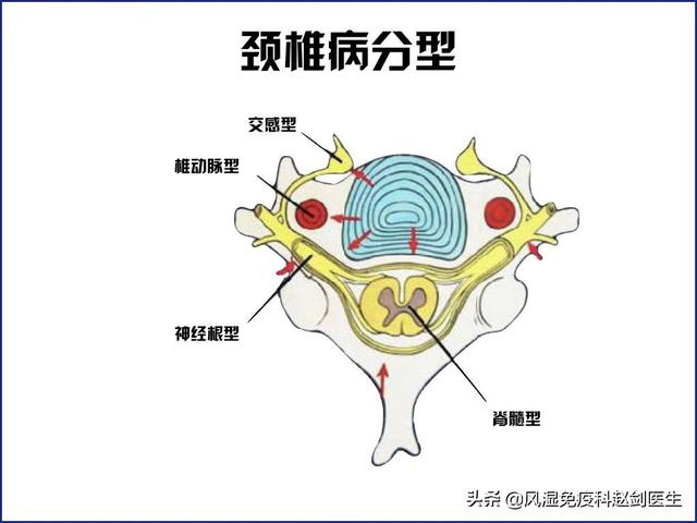 颈椎病有什么好办法治疗的短视频
:颈椎病正确的医治方法有哪些？  第5张